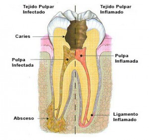 endodoncia en Pamplona