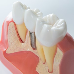 35280970 - close up of a dental implant model. selective focus.